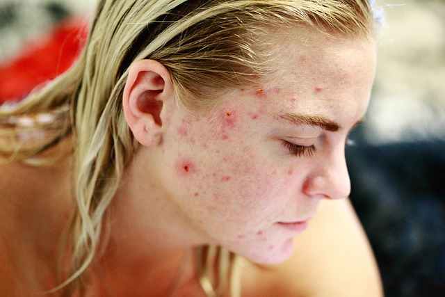 Frau mit Akne und Hautunreinheiten im Gesicht